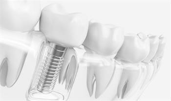 Implant Dentist Glendale | Glendale Dentist | Dentist Near Me | Dentist 85306