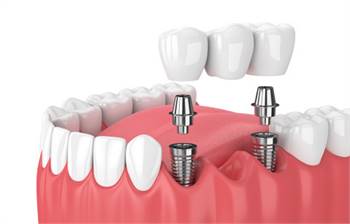 Is A Dental Bridge A Suitable Solution For Tooth Replacement?