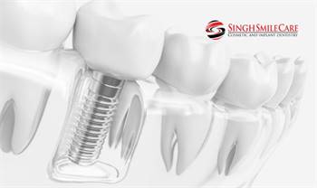 Dental Implants Glendale | Glendale Implant Dentist | Dentist 85306